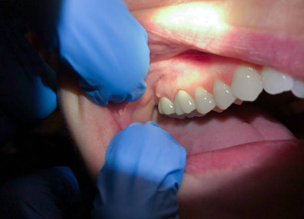 Best Emergency Treatment for Dental Infections or Abscesses in Garden Home Whitfd, OR